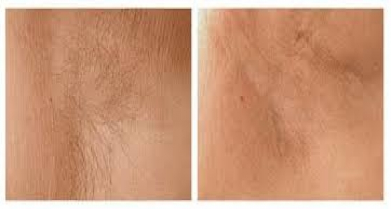 Szabadulj meg a nemkívánatos szőrszálaktól! Most 63%-os kedvezménnyel megteheted!